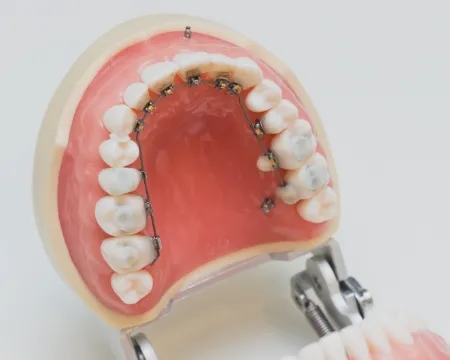 裏側(舌側)矯正治療_img